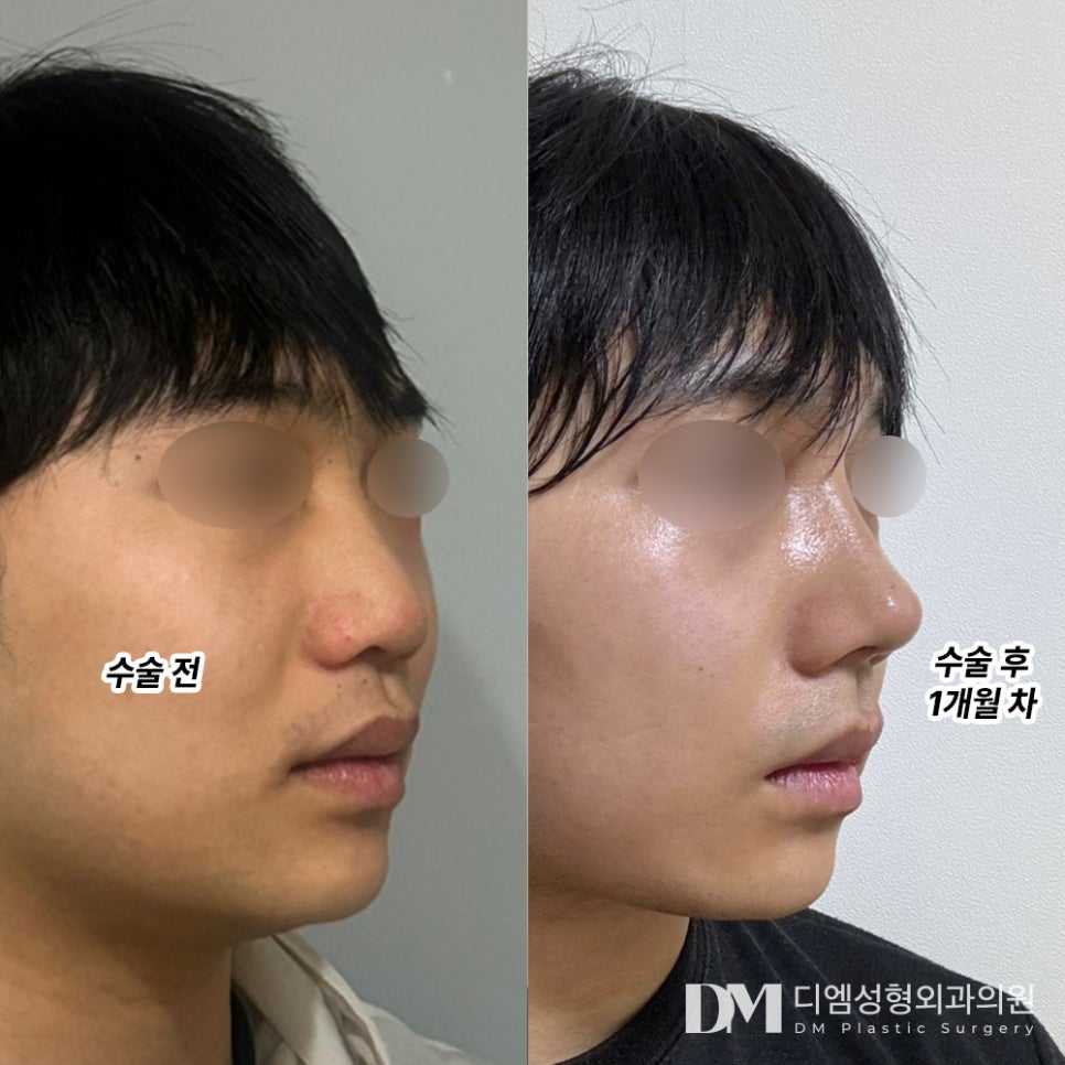 Feeling stressed because of a short nose? image 8