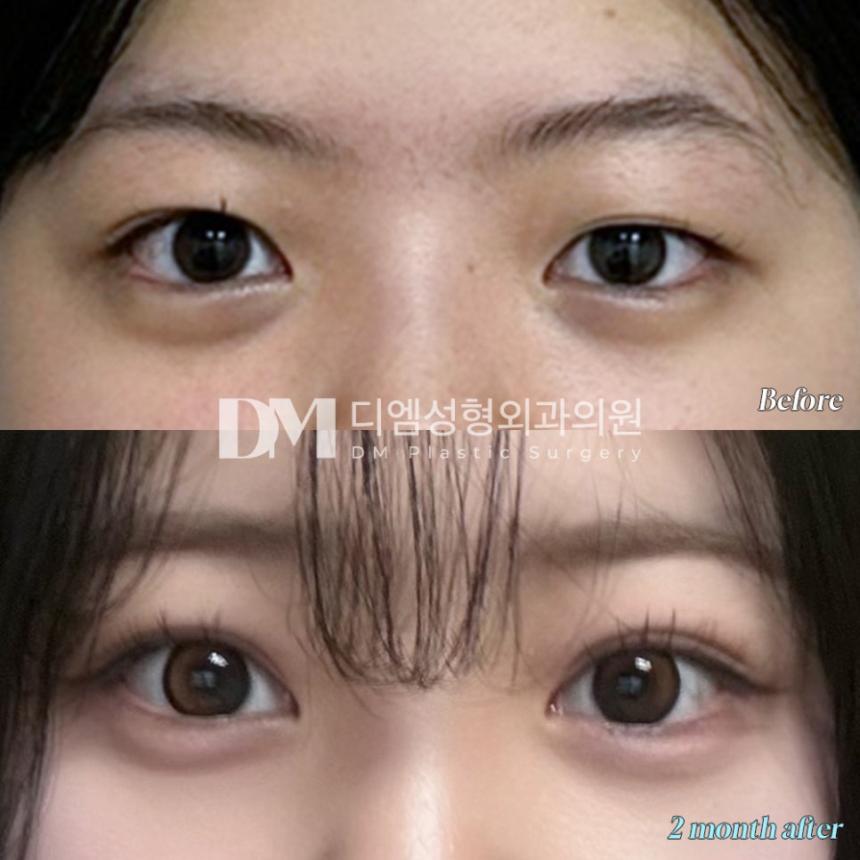 Revision Eyelid Surgery Review. “I was glad they created a line that suited my eyes well!” image 2