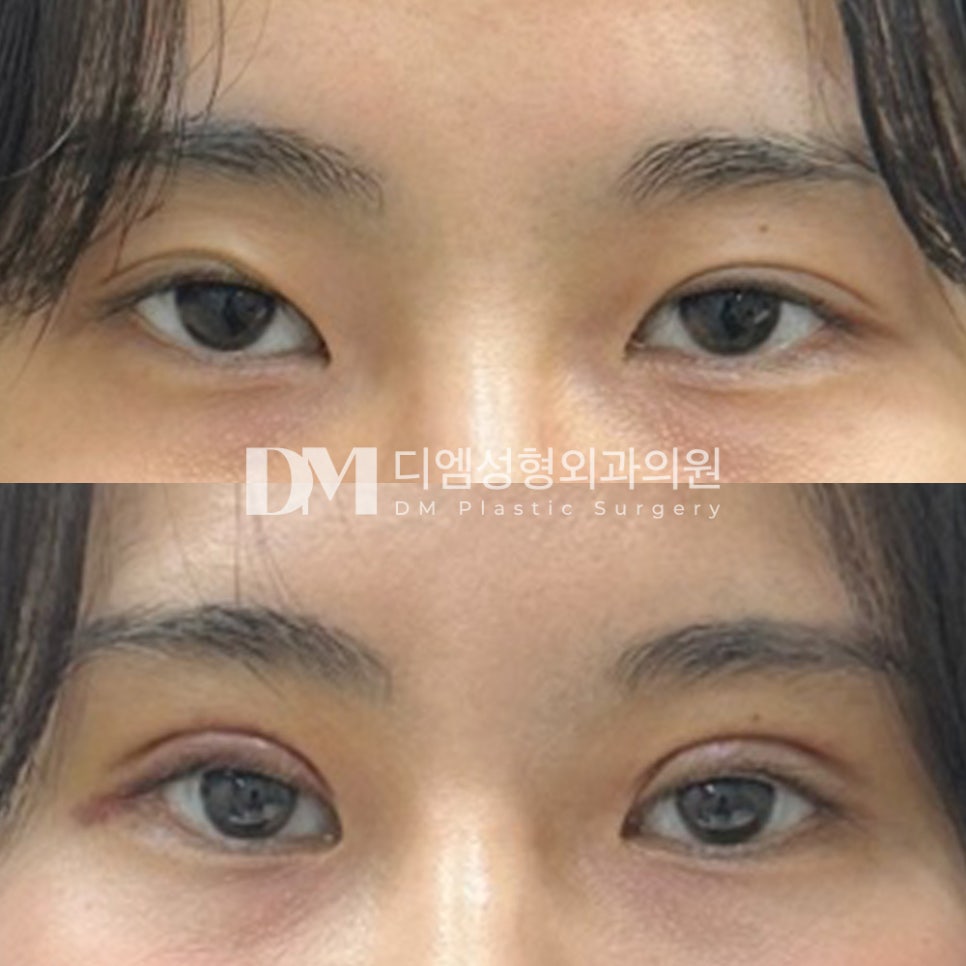 눈재수술 후기."눈매가 더욱 또렷해진 것 같아 기대가 됩니다 !" 관련 이미지 2