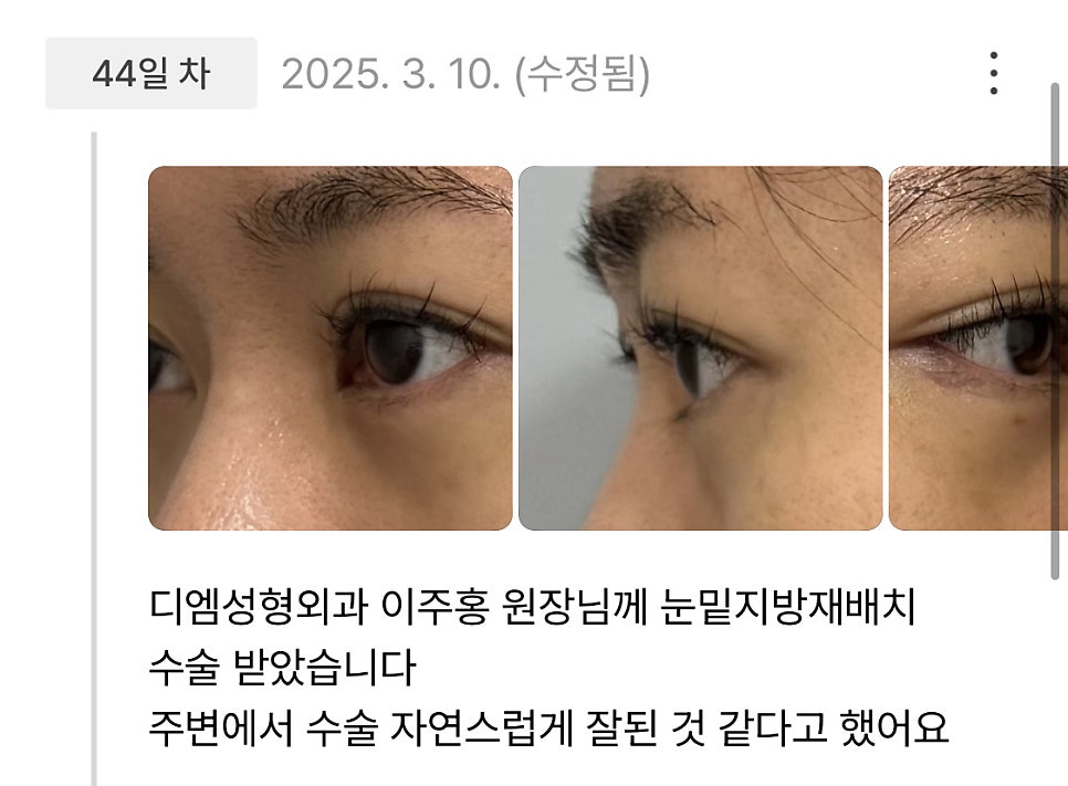 Lower Eyelid Fat Repositioning Review: “People around me said it looks natural and turned out well!” image 1