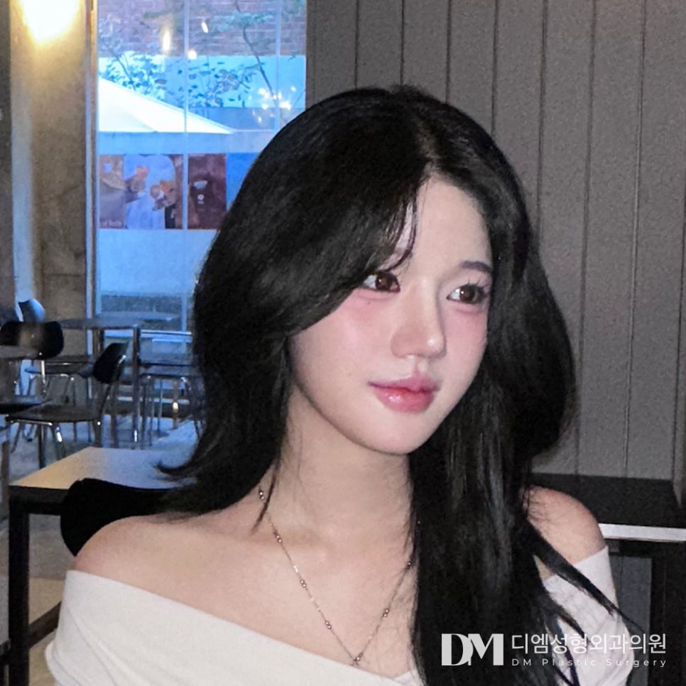 코끝성형, 입체적인 얼굴로! 관련 이미지 1