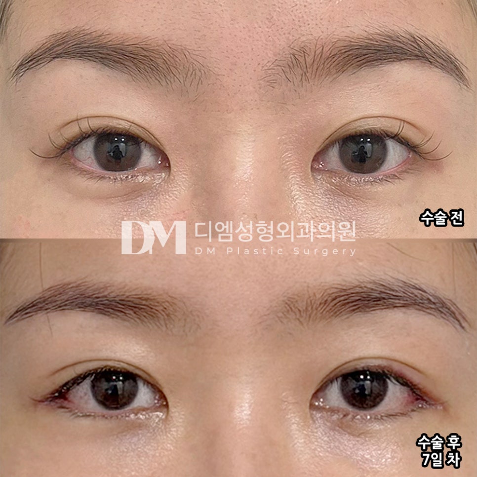 DM Lateral and Lower Canthoplasty Surgery Review, “I’m Increasingly Convinced I Made the Right Choice!” image 2