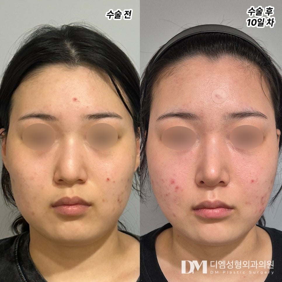 Bulbous Nose Surgery: If You’re Worried About a Large, Round Nasal Tip image 10