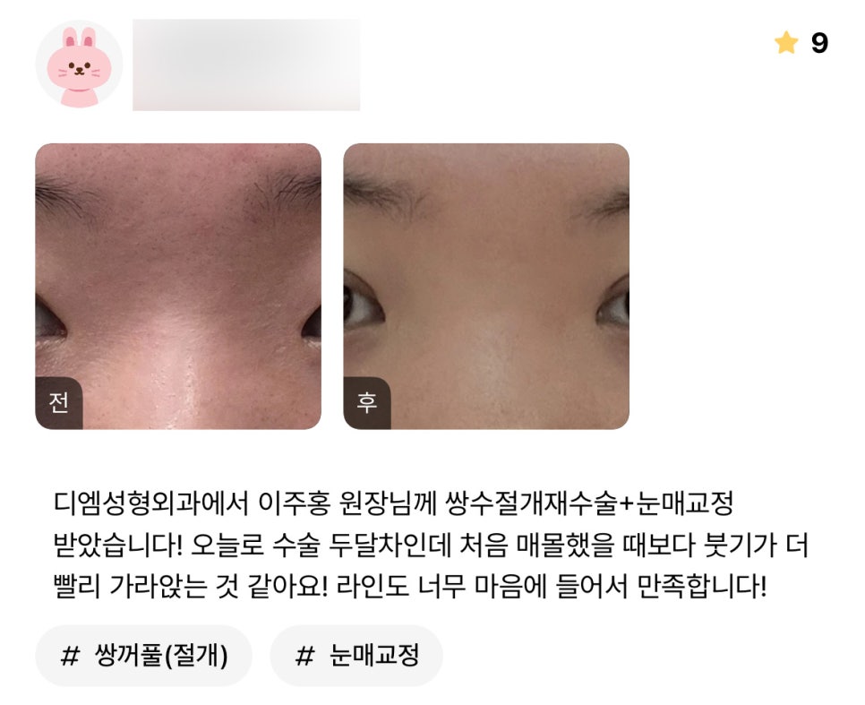 Revision Eye Surgery Review: “I’m so satisfied because I really love the crease!” image 1