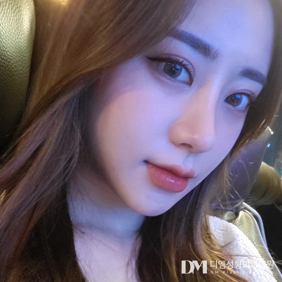 Double Eyelid Revision Surgery: Identifying the Exact Cause of Failure So There Won’t Be Any More Surgeries image 1