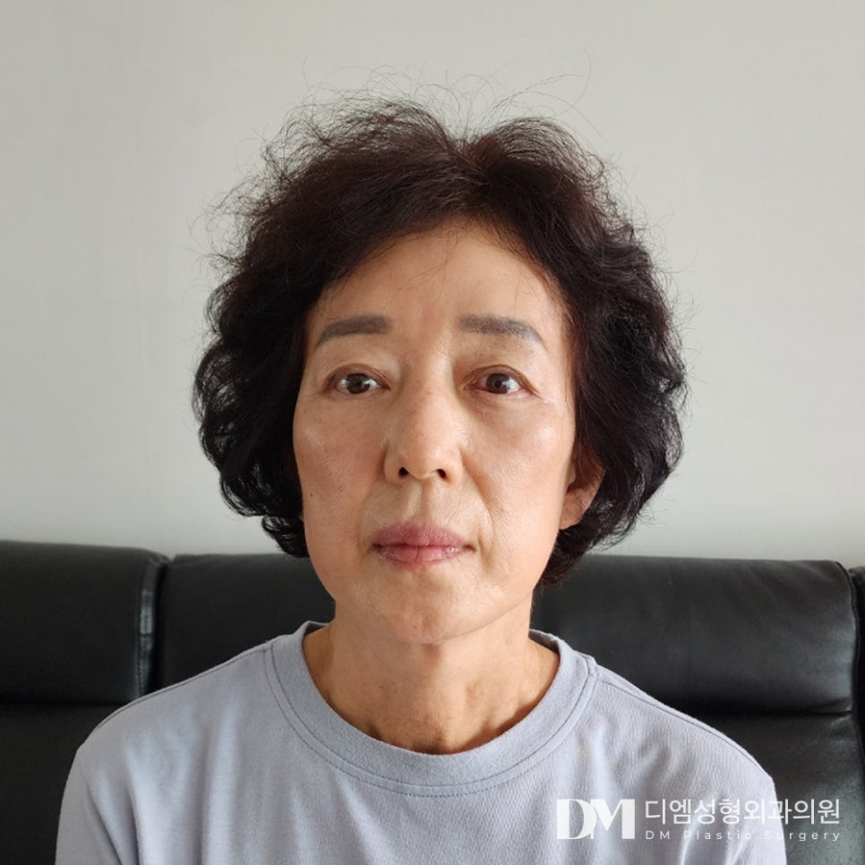 이마거상, 이마 주름과 처진 눈매를 한번에 교정하고 싶다면? 관련 이미지 11