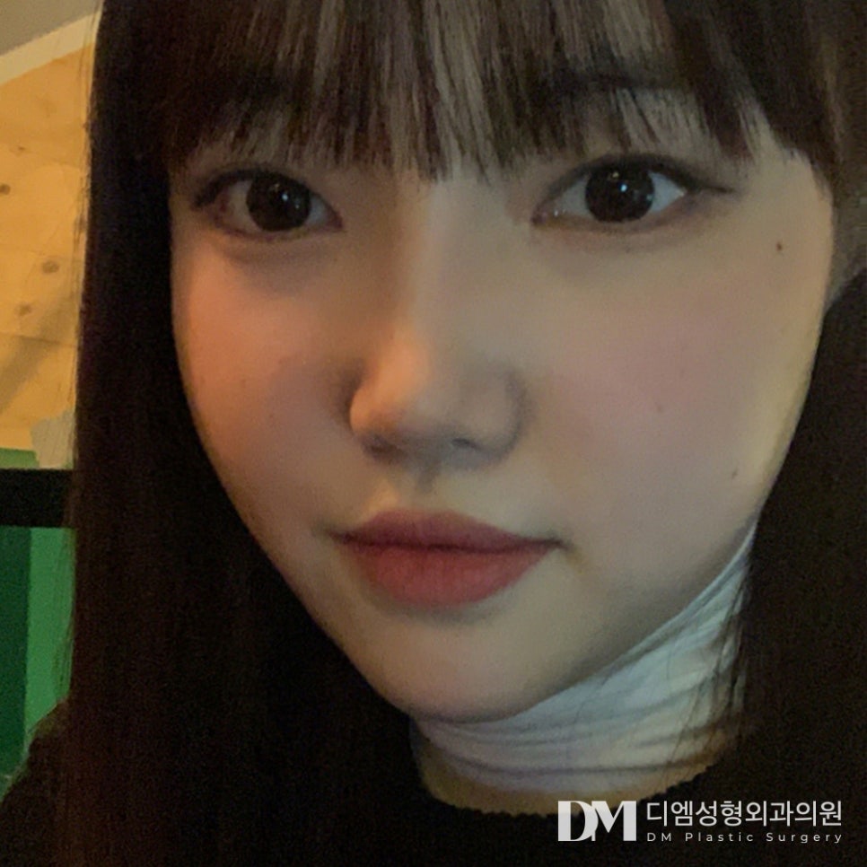 짧은코 성형, 얼굴 비율과 인상 동시 개선하기 ! 관련 이미지 1