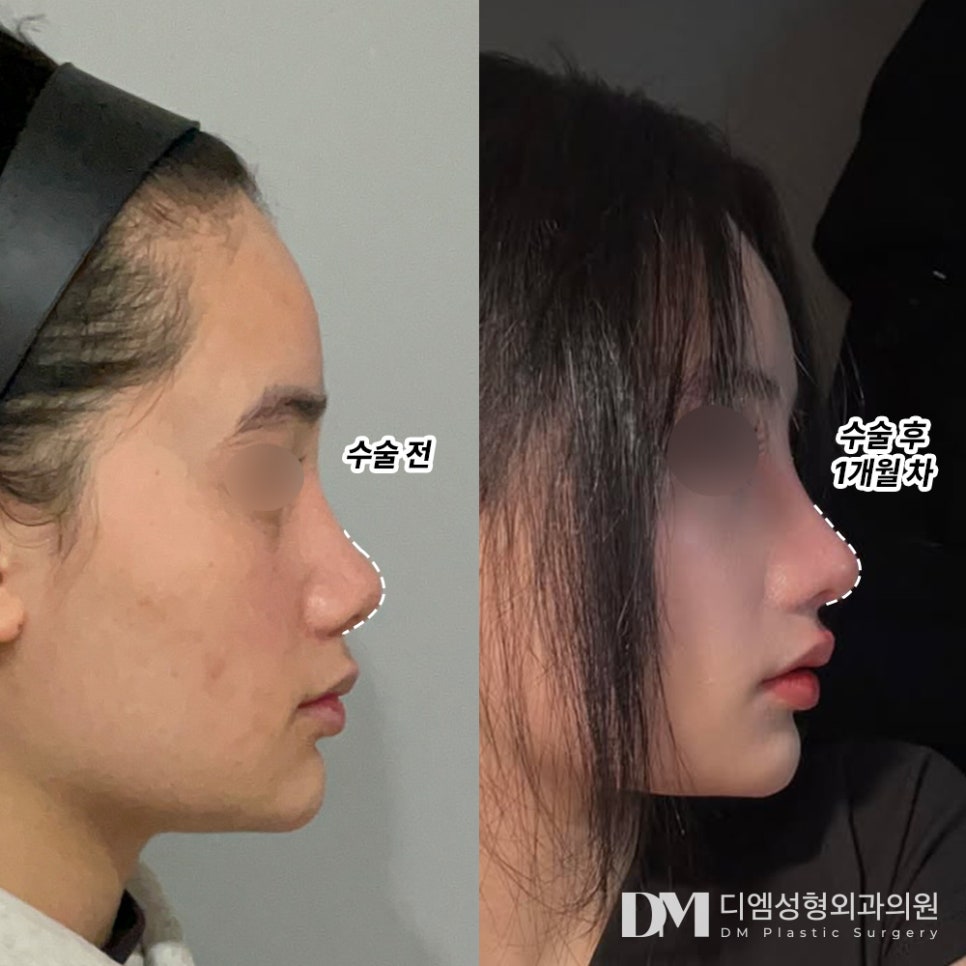 코재수술, 들리고 짧아지는 코 끝 해결하기 관련 이미지 10