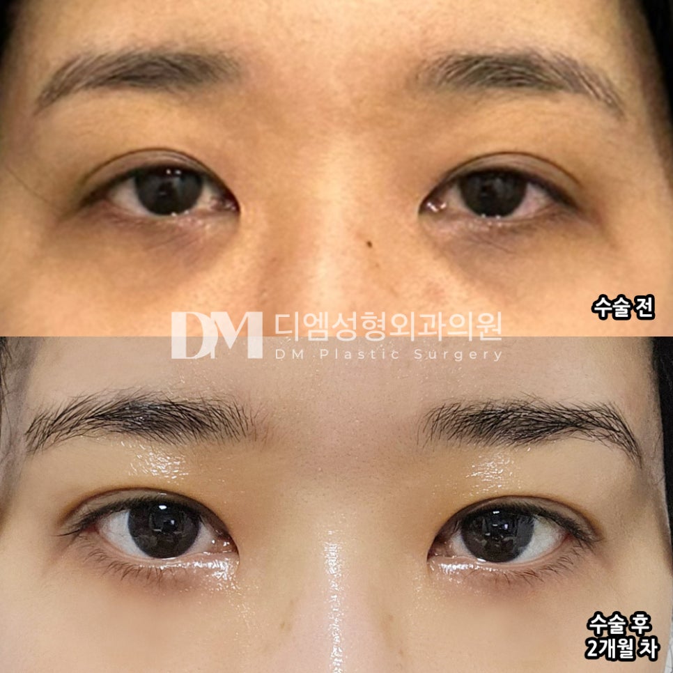 눈재수술 후기."라인만 딱 바꾸고싶었는데 맘에 듭니다!" 관련 이미지 2