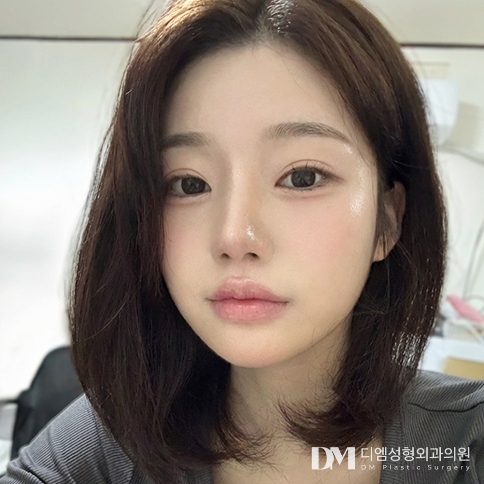 코성형 후 피노키오 코처럼 보이는 이유, 코가 높아서일까요? 관련 이미지 1