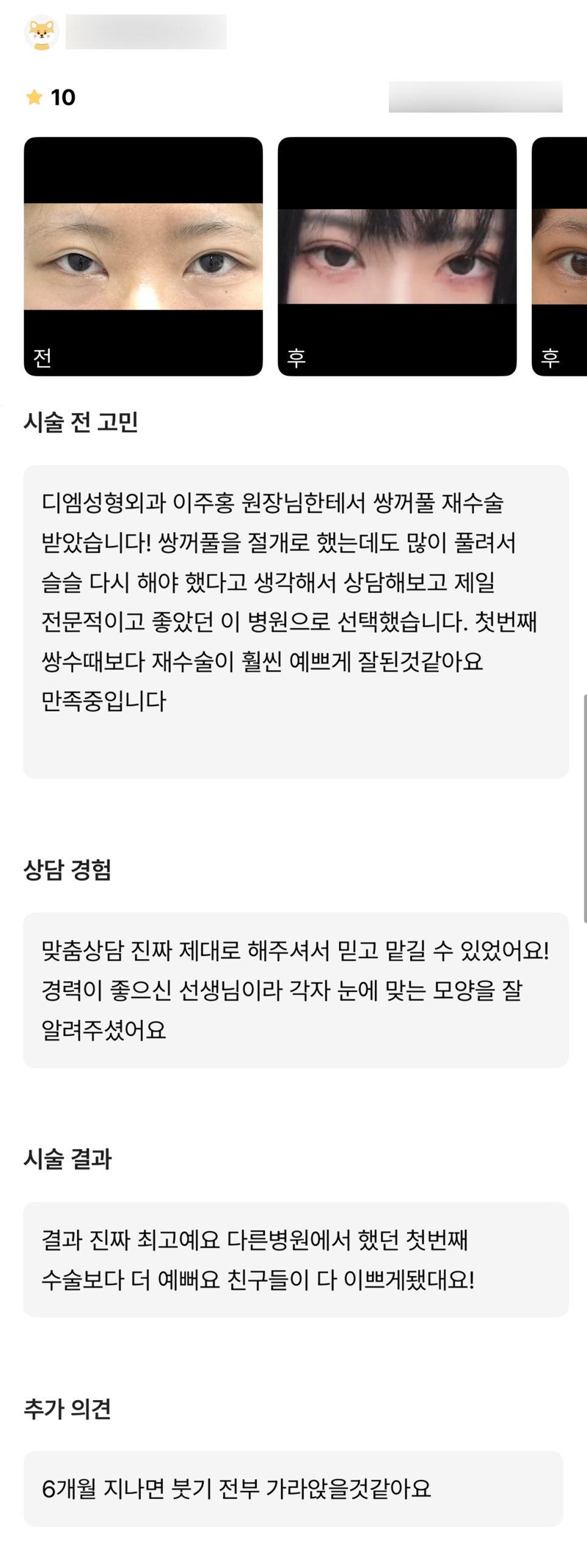 Revision Eyelid Surgery Review. "The result is really the best! My friends all said I became prettier!" image 1