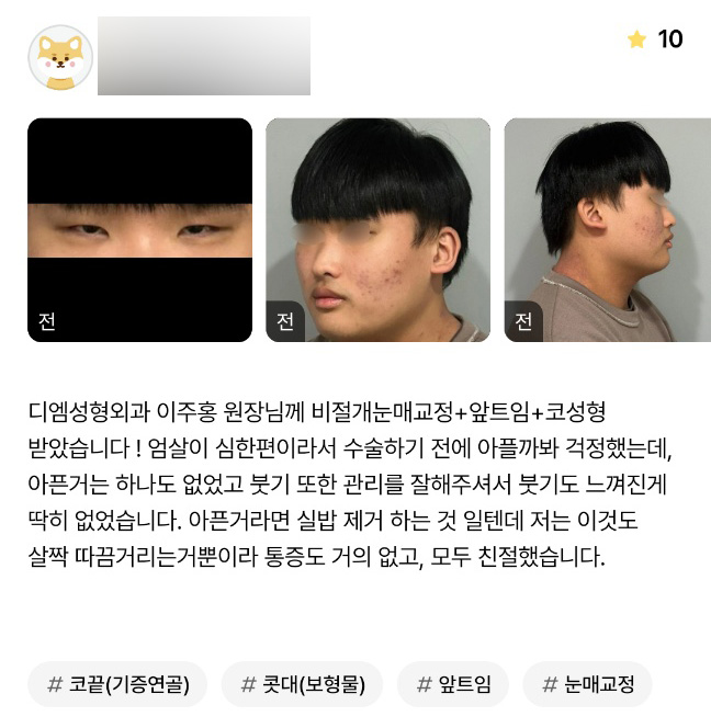 코성형 후기."통증도 거의 없고 모두 친절해요!" 관련 이미지 1