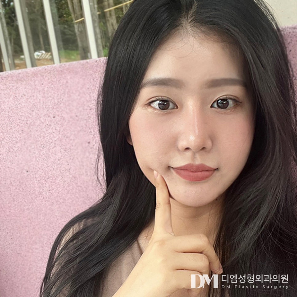 DM Lower Eyelid Fat Repositioning Review Photos: Smooth Under-Eyes Without Visible Hollows! image 1