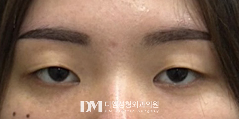 Eye-Shape Correction Combined with Double-Eyelid Surgery for More Defined Eyes! image 12