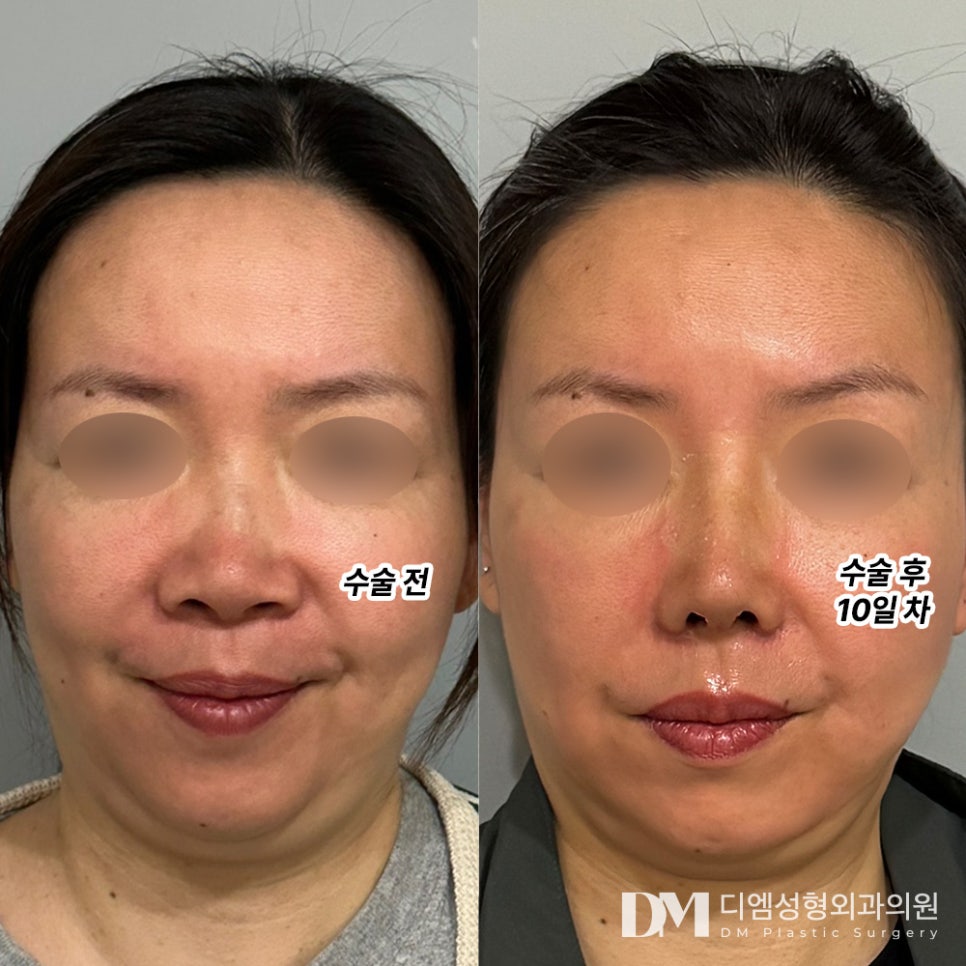 Improving a Bulbous Nose That Gives a Rustic Impression into a More Refined Image image 10