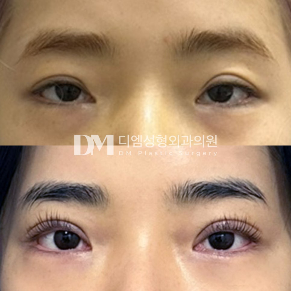 눈성형 후기."라인 너무 마음에 들어요!" 관련 이미지 2