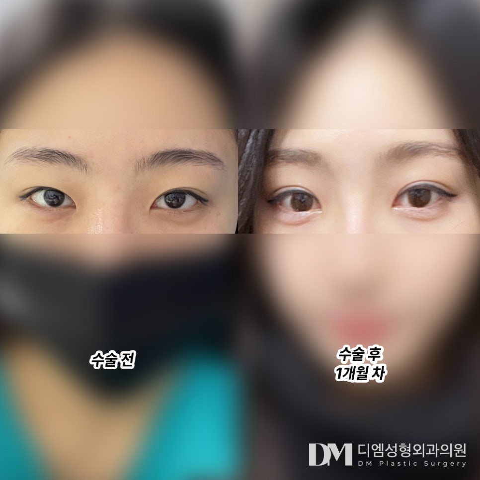 눈성형 후기."눈도 대칭이 맞아 거슬리지 않아 좋아요 !" 관련 이미지 2