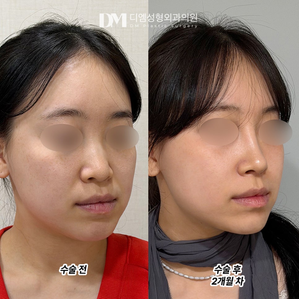 DM Rhinoplasty Review, “They’re kind and do a great job matching my face!” image 2