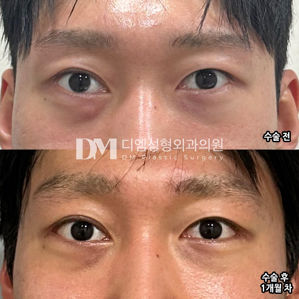 눈성형 후기."제가 원하는 스타일로 진행돼서 맘에 들어요!" 관련 이미지 2