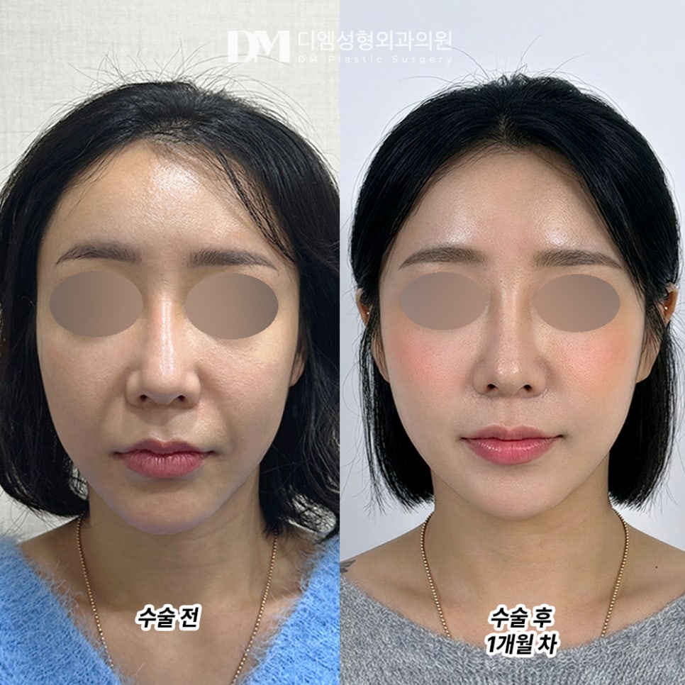 디엠 반거상 전후사진, 깊은 팔자주름이 고민이라면? 관련 이미지 2