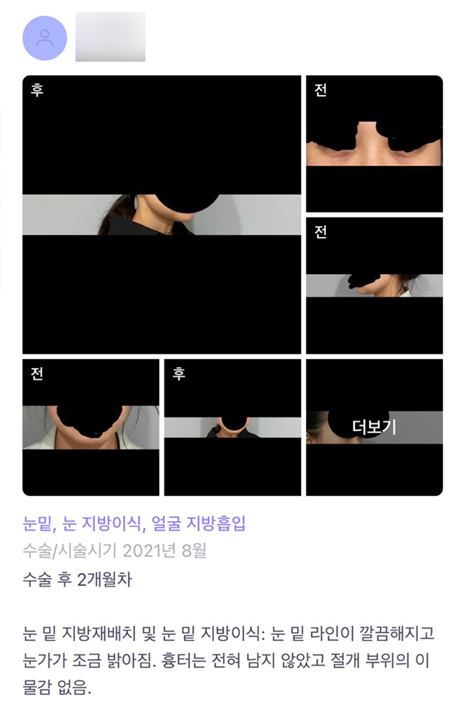 눈밑지방재배치 후기."눈 밑 라인이 깔끔해지고 밝아졌어요!" 관련 이미지 1