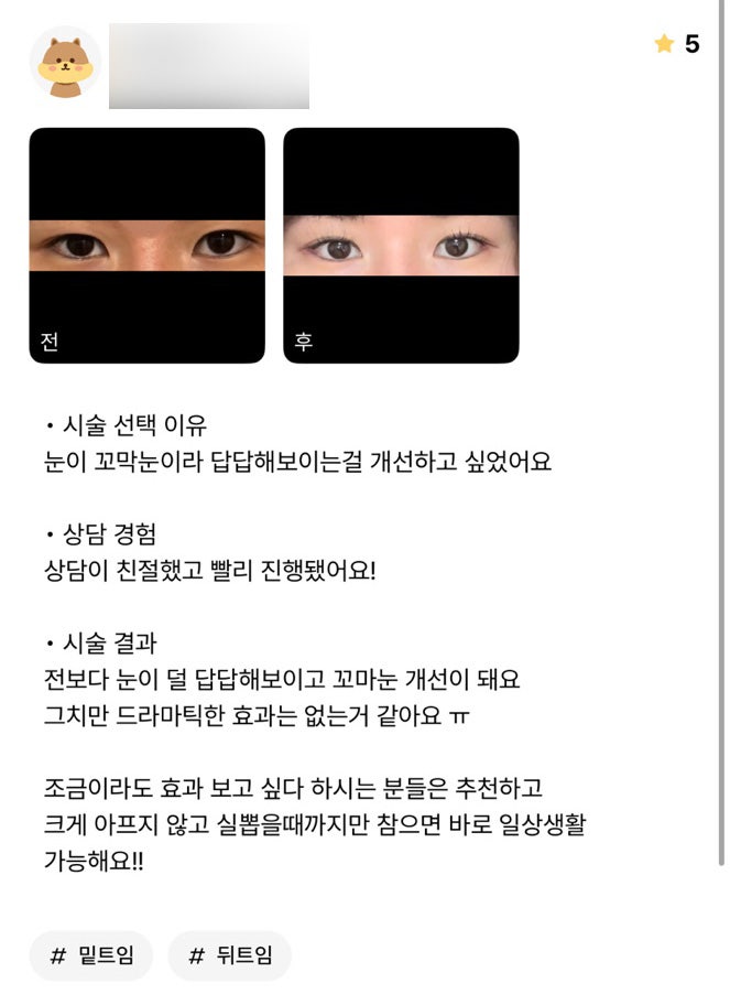 Bbang Eye Corner Surgery Review: "My eyes look less cramped than before, and my narrow eyes have improved!" image 1