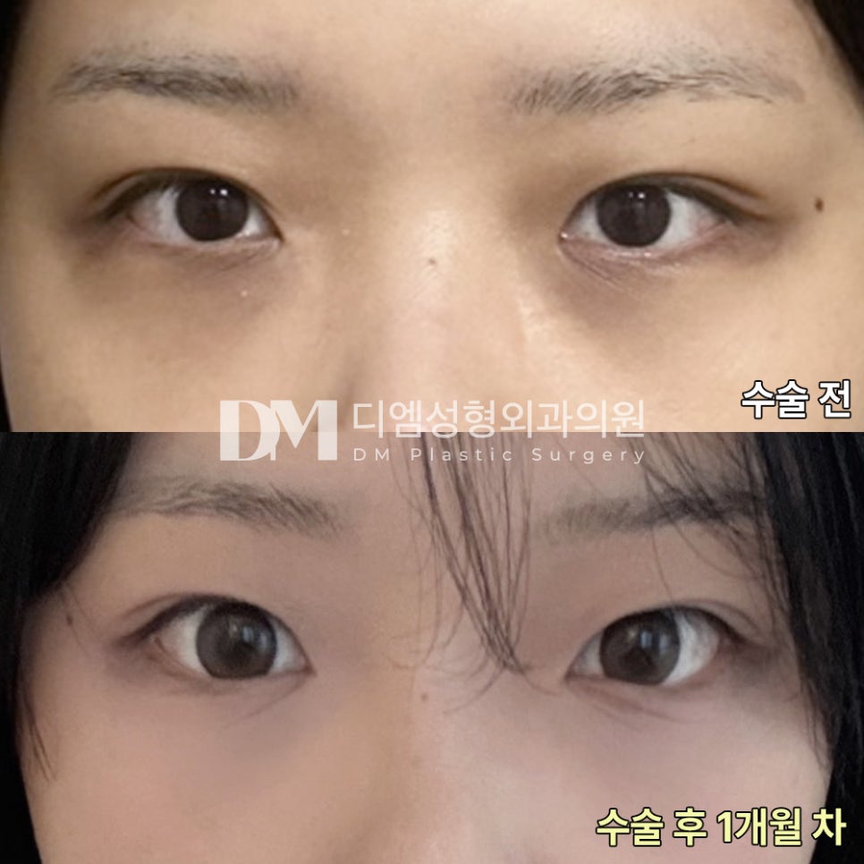 눈밑지방재배치 후기."한번의 수술로 인상부터 안색까지 환하게 변하고 효과가 드라마틱해요!" 관련 이미지 2