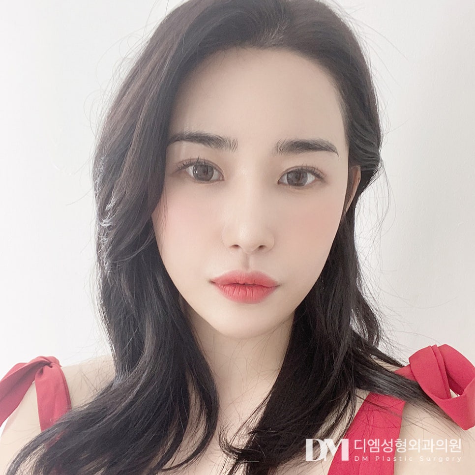 Short Nose Rhinoplasty, Considering Overall Facial Harmony image 1