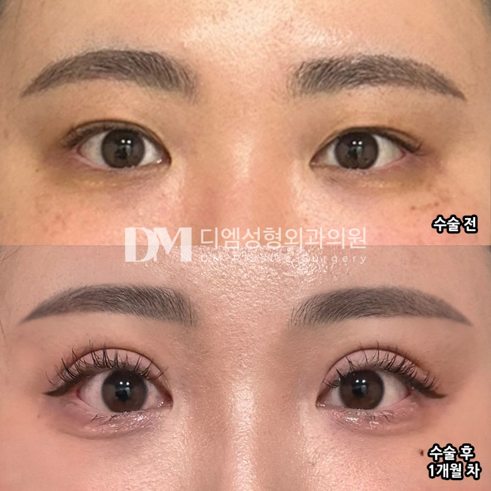 눈재수술 후기."붓기도 잘빠지고 만족합니당!" 관련 이미지 2
