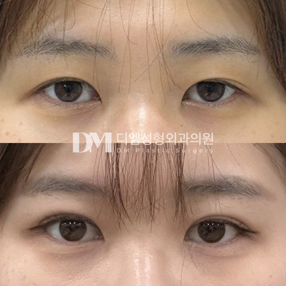 눈성형 후기."친구들도 수술했는지 몰라봐요! 대만족!" 관련 이미지 2