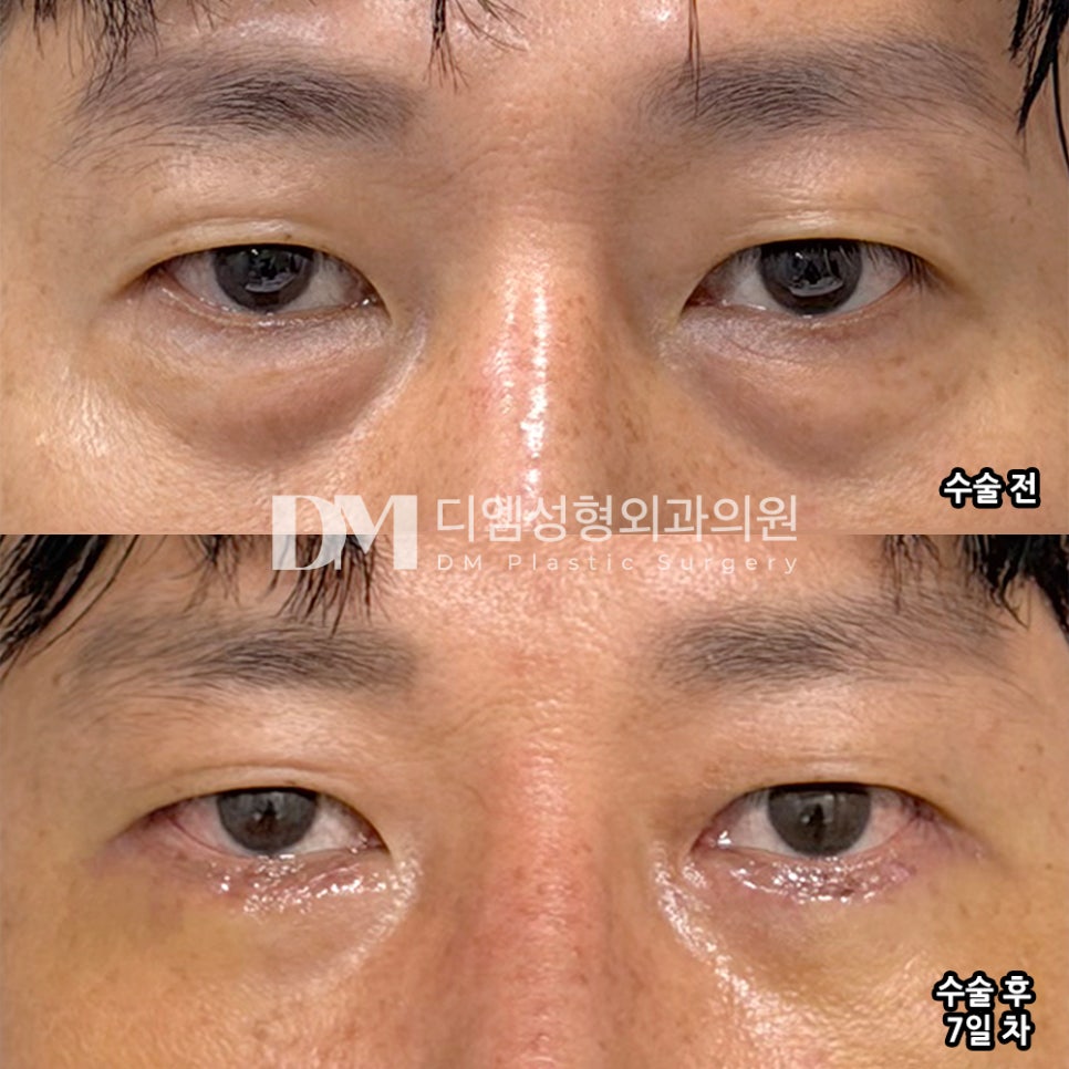 DM Lower Eyelid Surgery Review, “It turned out so naturally, and I’m very satisfied!” image 2