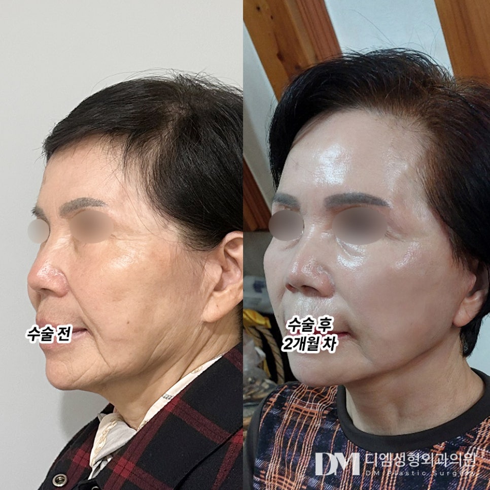 Facelift Review. "I’m satisfied that the side lines have been refined a lot, and I’m glad I had it done before it was too late." image 2
