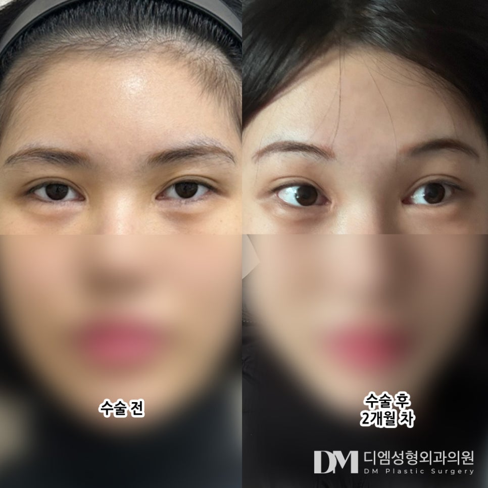 이마거상 후기."눈모양이 변하지 않고 라인이 높아져 시원해보여요!" 관련 이미지 2