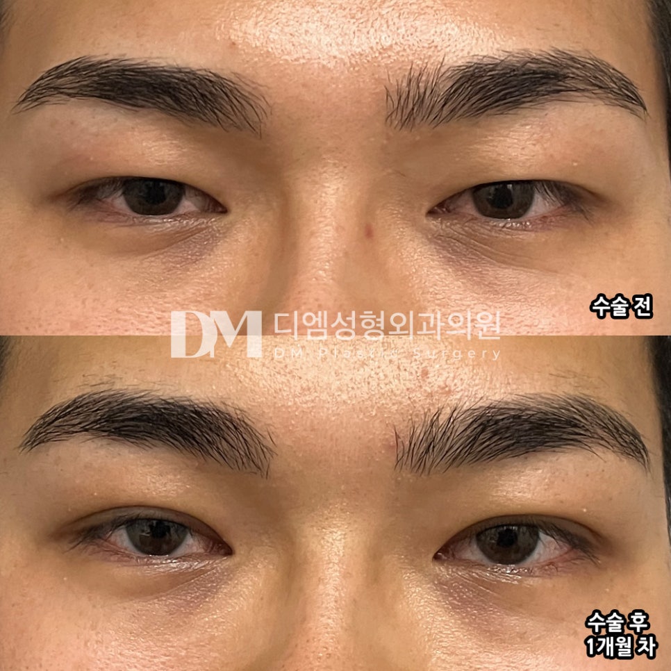 눈성형 후기."결과에 너무 만족해요!" 관련 이미지 2
