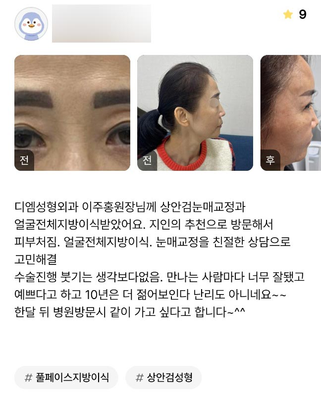 얼굴지방이식 후기."10년은 더 젊어보인다 난리도 아니네요~~" 관련 이미지 1