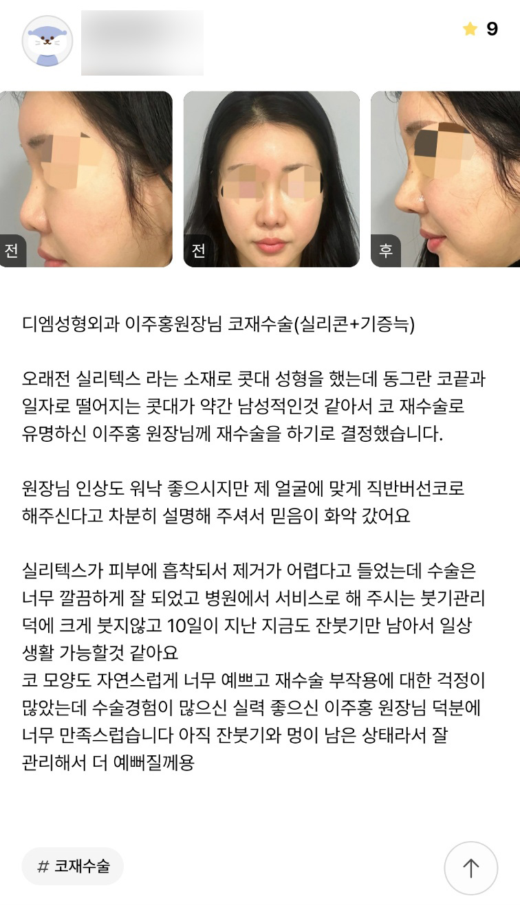 Revision Rhinoplasty Review. “I’m so satisfied because the shape of my nose looks naturally beautiful!” image 1