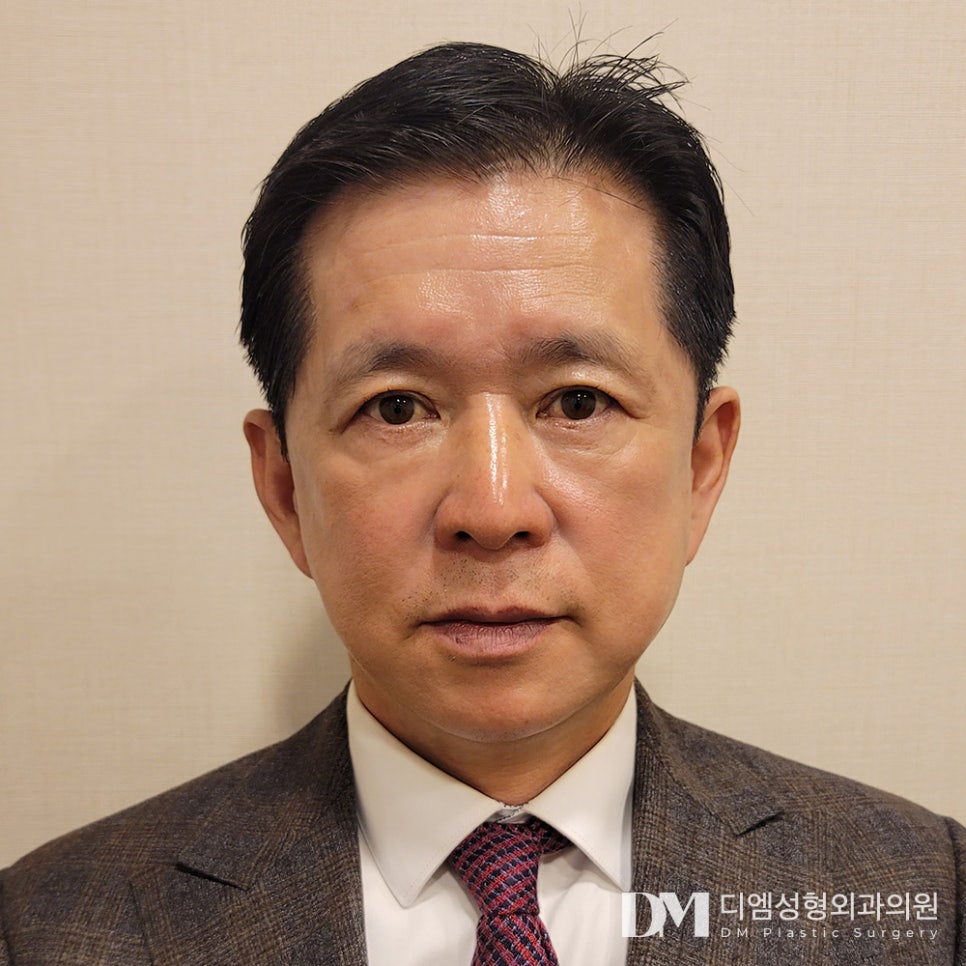 하안검, 밝고 젊어보이는 인상 만들기 관련 이미지 1