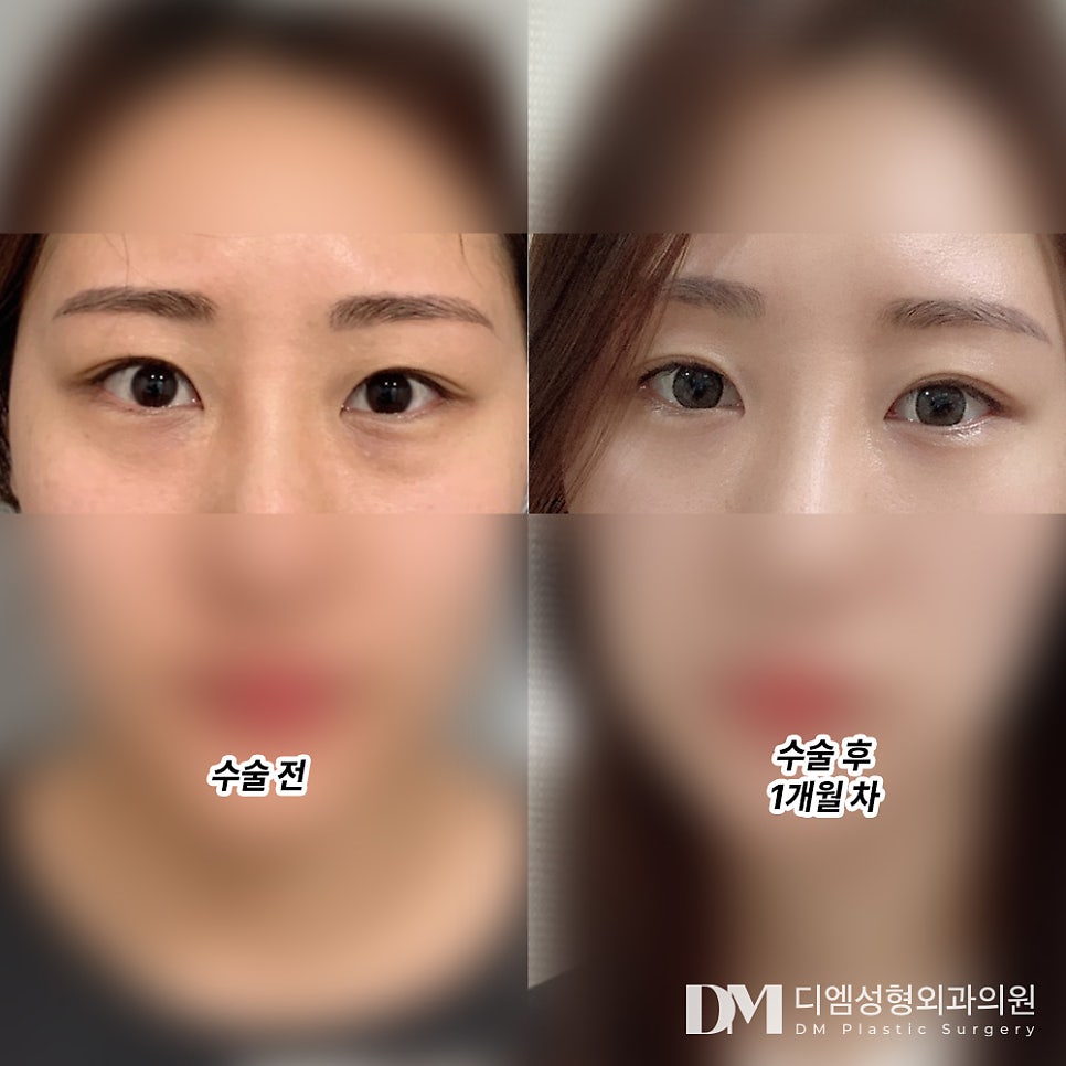눈밑지방재배치 후기."눈밑이 평평해지니까 인상이 확실히 깔끔해보이고 어려보여서 만족합니다!" 관련 이미지 2