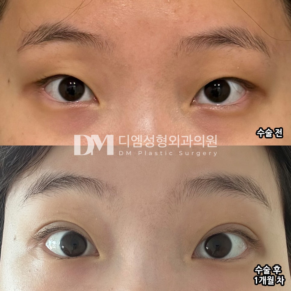 Double-Eyelid Surgery Review: “I’m truly grateful to the director for performing the surgery precisely according to my needs!!” image 2
