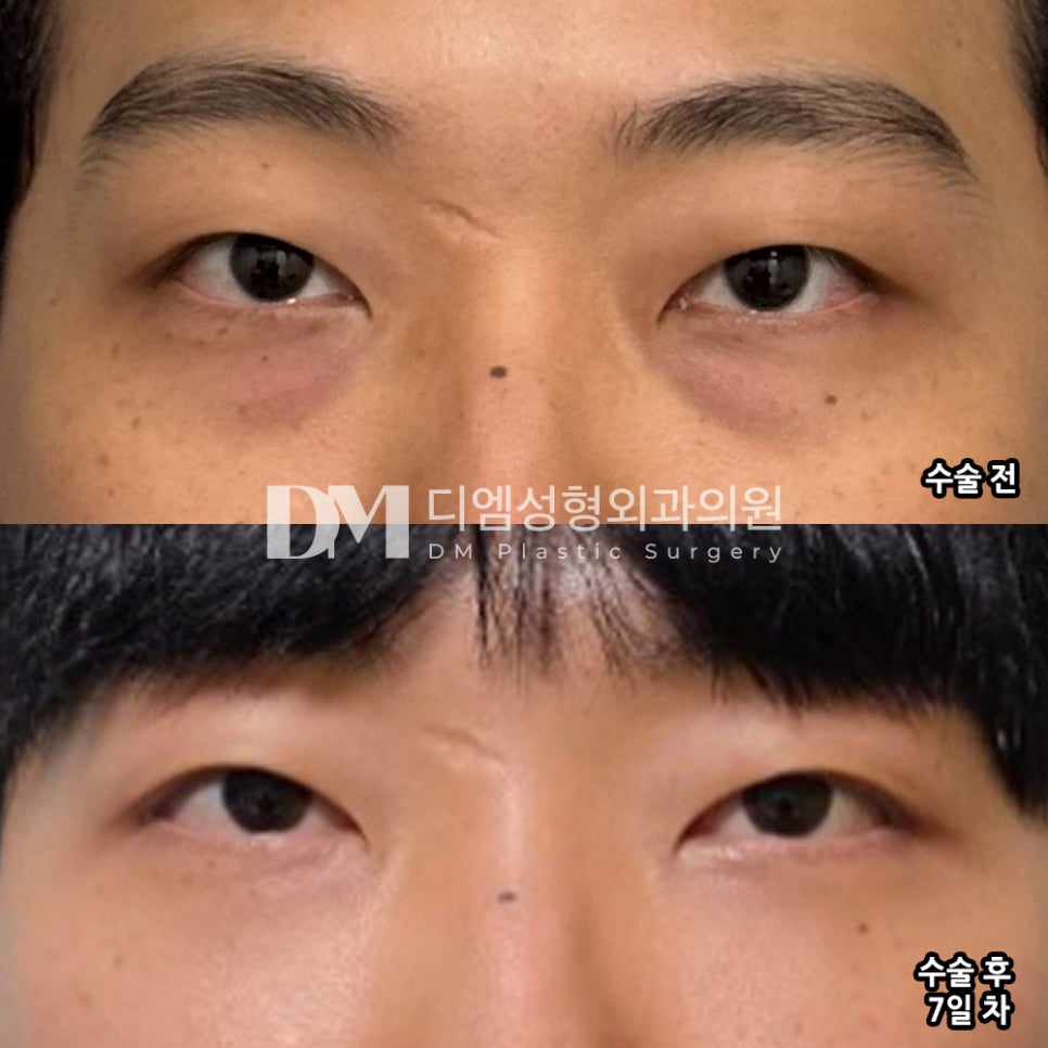 눈밑지방재배치, 동안 효과 뿐 아니라 환한 인상까지 ! 관련 이미지 6