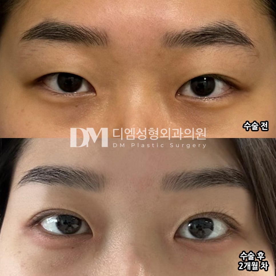 눈성형 후기."자연스럽고 원했던 대로 모양 예쁘게 잡혔어요!" 관련 이미지 2