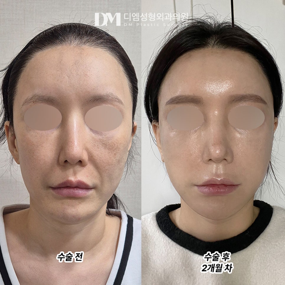 DM Face Lift / Forehead Lift Surgery Review, &ldquo;My skin became smooth and firm, and everything lifted right up!&rdquo; image 2