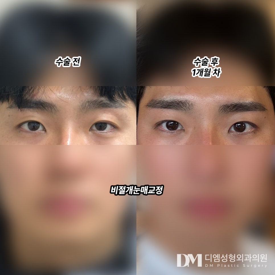 눈성형 후기."제가 원하는 눈 모양이 나와서 대만족입니다!" 관련 이미지 2