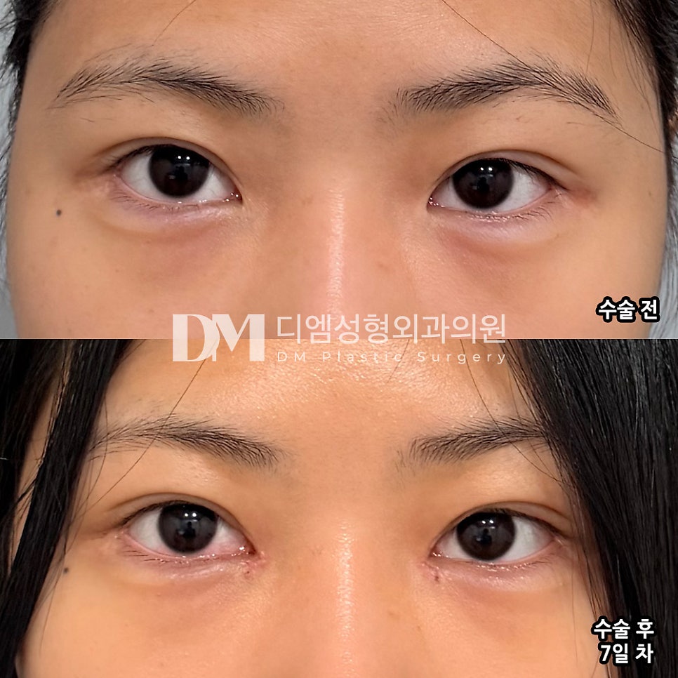 Eyelid Surgery Review. "The hospital seemed to favor a natural look, so it suited me well!" image 2