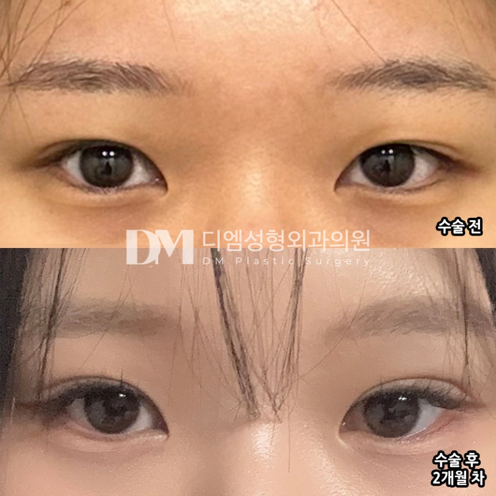 DM Eyelid Revision Surgery Review, “I liked that they only recommended the surgery that was truly necessary!” image 2