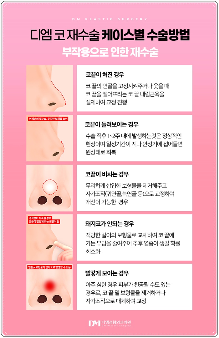 코재수술, 첫코성형 실패 원인 분석이 우선! 관련 이미지 9