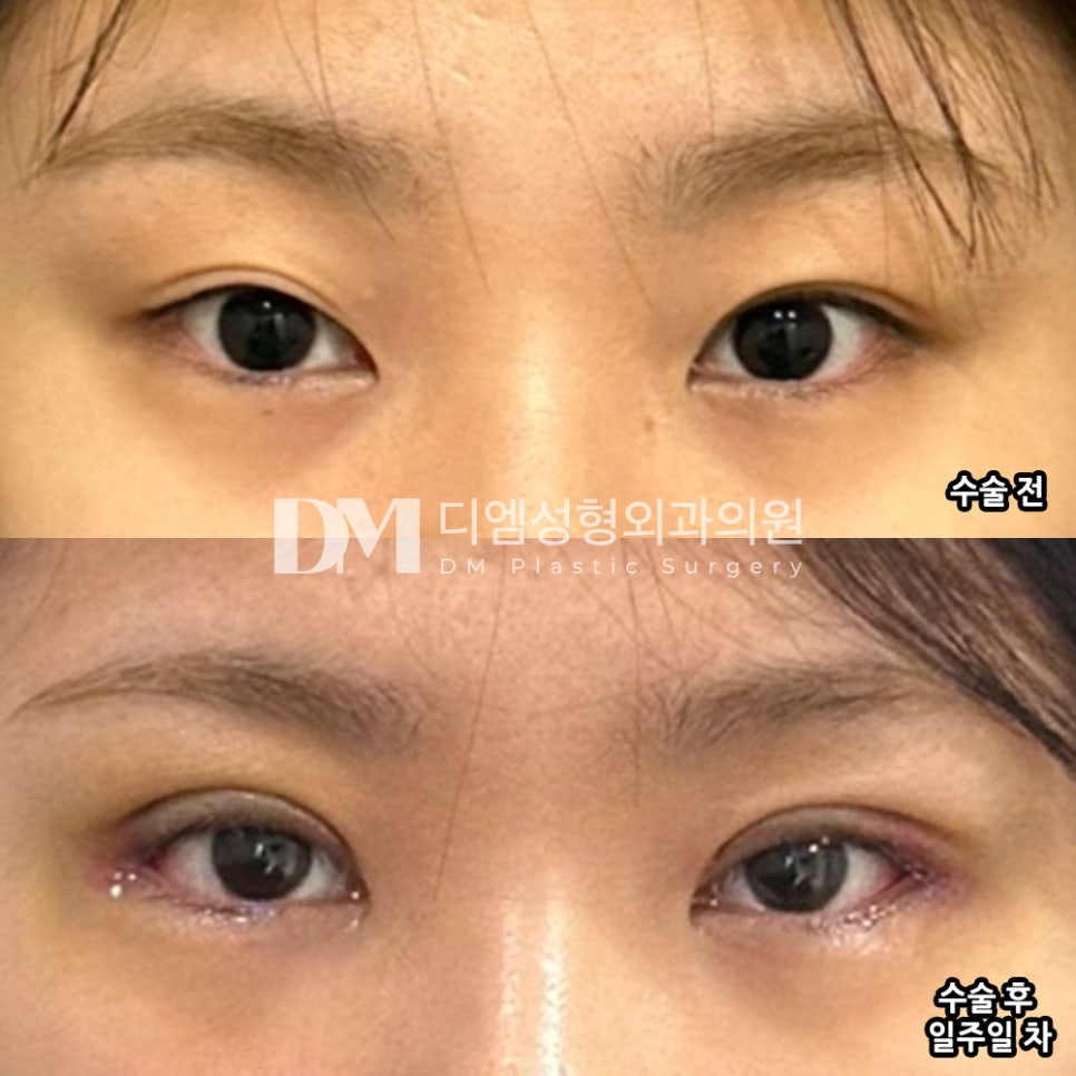 Double-Eyelid Surgery Review: “There was no pressure, and the swelling went down quickly, so I’m very satisfied!” image 2