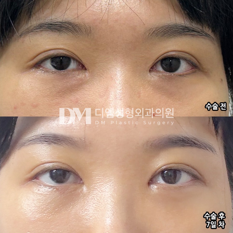 눈밑지방재배치 후기."벌써 변화가 느껴져요!" 관련 이미지 2