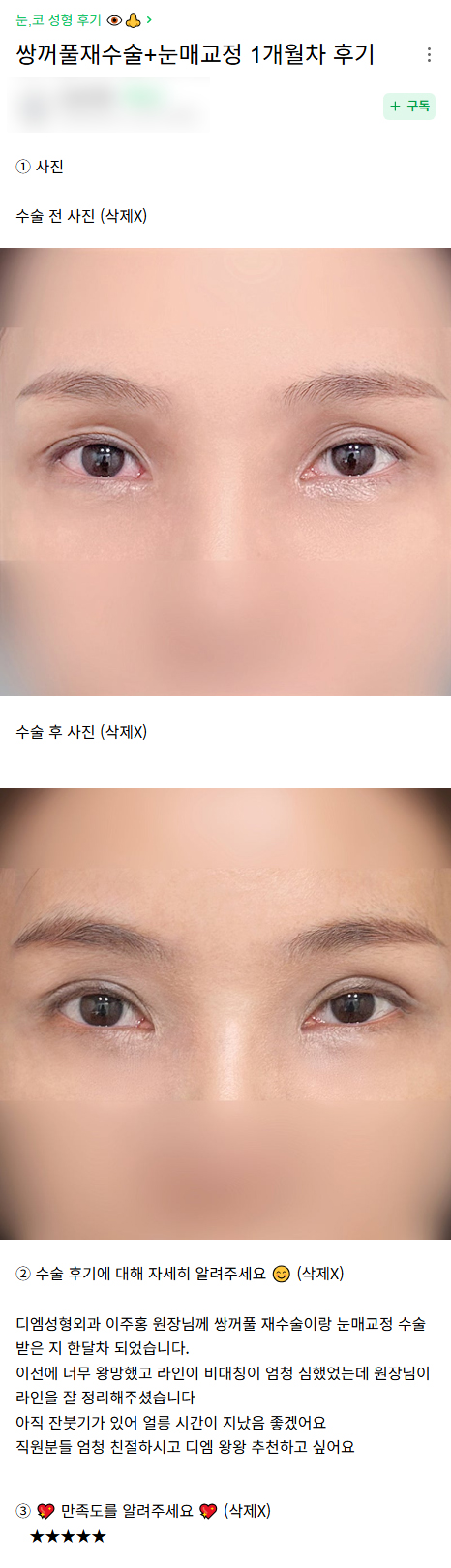 DM Revision Eyelid Surgery/Eye-Shape Correction Surgery Review, “The Doctor Refined the Eyelid Line So Well!” image 1