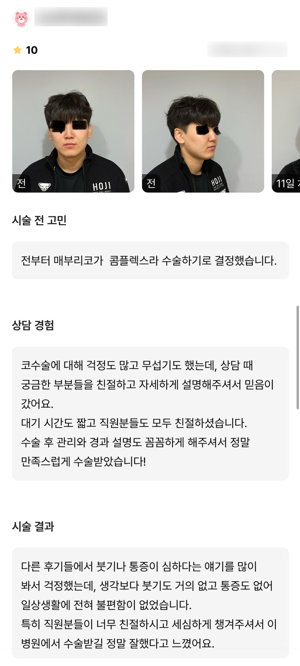 코성형 후기."생각보다 붓기도 거의 없고 통증도 없어 일상 생활에 전혀 불편함이 없었습니다" 관련 이미지 1